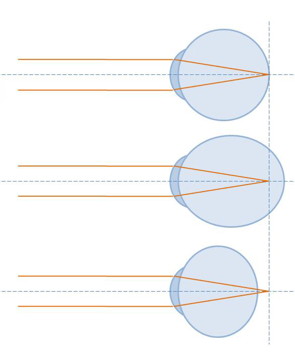 Eye diagrams showing emmetropia, myopia with focus in front of the retina, and hyperopia with focus behind it.